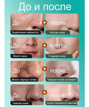 Gel for washing the face from acne and black dots - Buy Online on GoSupps.com