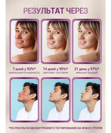 NBR Cosmetics Person's serum against acne and acne 30 ml - Buy Online on GoSupps.com