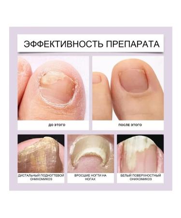 Nail fungus Care fluid bee poison contribute to growth - Buy Online on GoSupps.com