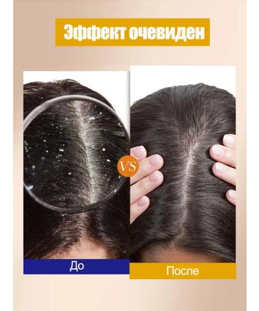 OUTMIX Shampoo against dandruff and itching quickly and effectively 300 ml - Buy Online on GoSupps.com