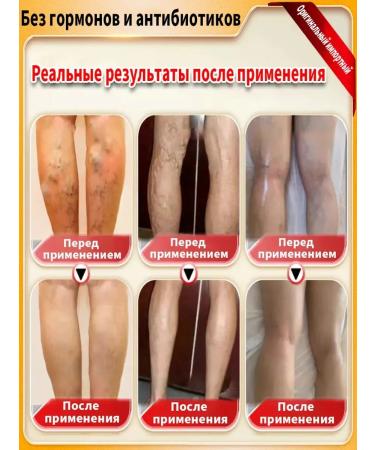 Varifite gel from varicose veins on the legs of Chinese 250g - Buy Online on GoSupps.com