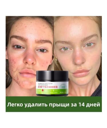 DRSKINVITA Acne cream for women 30g - Buy Online on GoSupps.com
