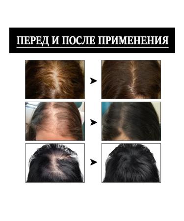 JaySuing Prevents loss Essence nourishes accelerate hair growth - Buy Online on GoSupps.com