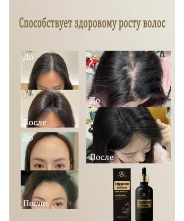 LYDIMOON 5 bottles of essence against hair loss of 50 ml - Buy Online on GoSupps.com