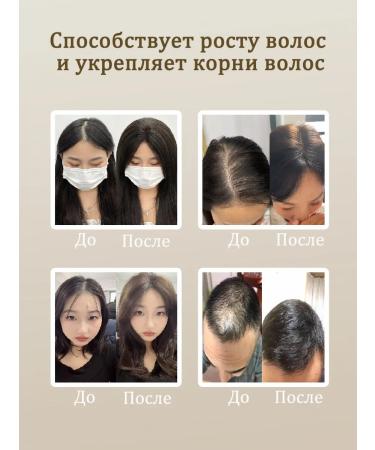 LYDIMOON 5 bottles of essence against hair loss of 50 ml - Buy Online on GoSupps.com