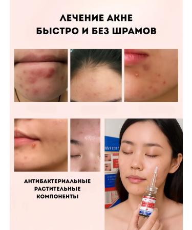 TA1612 Acne and pimple remedy - Buy Online on GoSupps.com