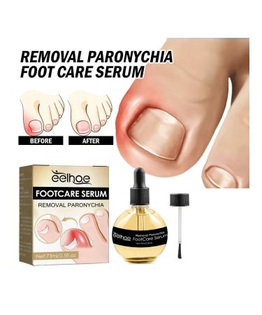 Eelhoe elimination of panarization of serum to care