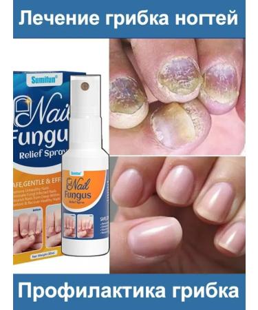 DRSKINVITA Spray from nail fungus fast effect 30ml - Buy Online on GoSupps.com