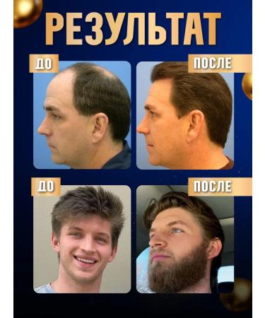 STEELBEARD Hair and beard growth 5% mesoroller - Buy Online on GoSupps.com
