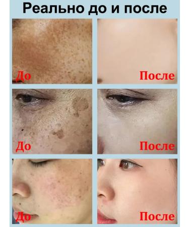 Cream against freckles Removing Sun Sun spots Removing - Buy Online on GoSupps.com