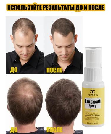 LYDIMOON Hair growth spray 30ml - Buy Online on GoSupps.com