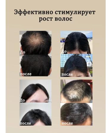 LYDIMOON Hair growth spray with ginger 30 ml 5 bottles - Buy Online on GoSupps.com