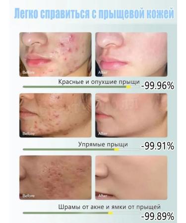 LYDIMOON Acne cream with azelainic acid 30 g - Buy Online on GoSupps.com