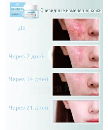 LYDIMOON Acne cream with azelainic acid 30 g - Buy Online on GoSupps.com