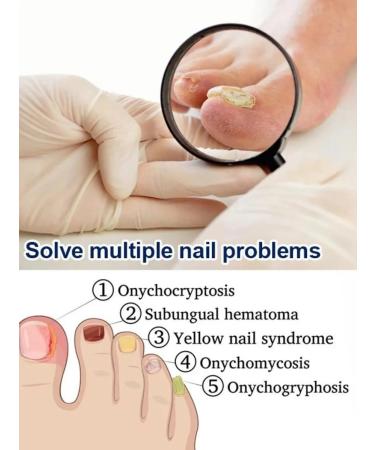 latiuz Remedy for mycosis of the legs - Buy Online on GoSupps.com