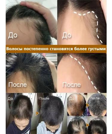 Shampoo against falling out and for the growth of the wave （5 bottles） - Buy Online on GoSupps.com