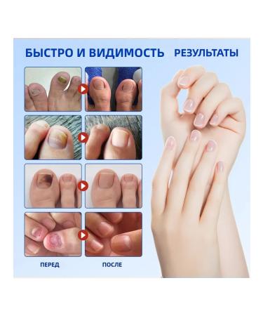 Patch to restore nail health contributes to health - Buy Online on GoSupps.com