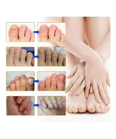 Delicate patching from nail fungus are easy to use p - Buy Online on GoSupps.com