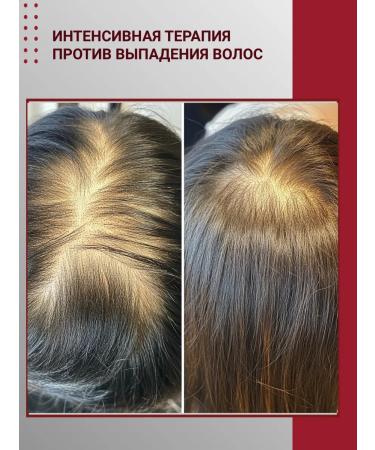 Vitex PRO MINEXIL Strengthening Balm for Weakened Hair Prone to Hair Loss - Buy Online on GoSupps.com