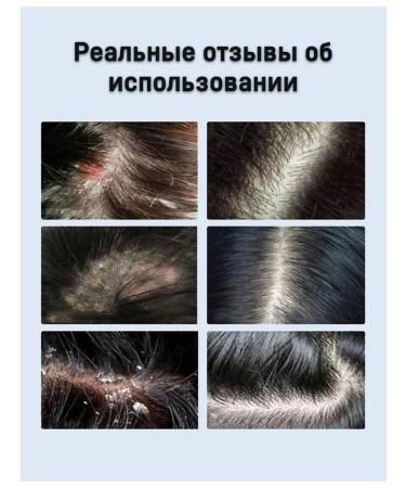 Hunmui Anti-dandruff shampoo with selenium disulfide against seborrhea and itching 250 ml - Buy Online on GoSupps.com