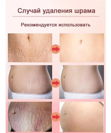 Aichun Beauty Cream to eliminate stretch marks scars 100 g - Buy Online on GoSupps.com