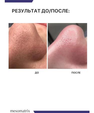 Mesomatrix Professional Gels for ultrasonic facial cleaning and decking set - Buy Online on GoSupps.com