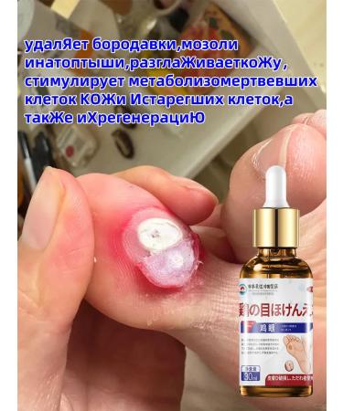 DRSKINVITA Getting rid of corns and calluses