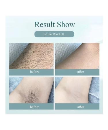 Laser epilator 9ylhejRe - Buy Online on GoSupps.com