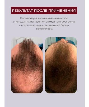 FOLTENE Pharma Hair loss for men Foltene 12 pcs - Buy Online on GoSupps.com