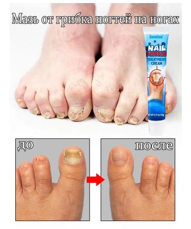 Antibacterial nail cream 20 ml