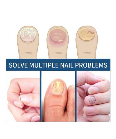 Eelhoe fungus of gray nail thickenation restoration manual - Buy Online on GoSupps.com