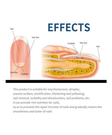 Eelhoe fungus of gray nail thickenation restoration manual - Buy Online on GoSupps.com