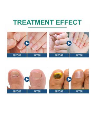 Eelhoe fungus of a gray nail thickening restoration manual ... - Buy Online on GoSupps.com