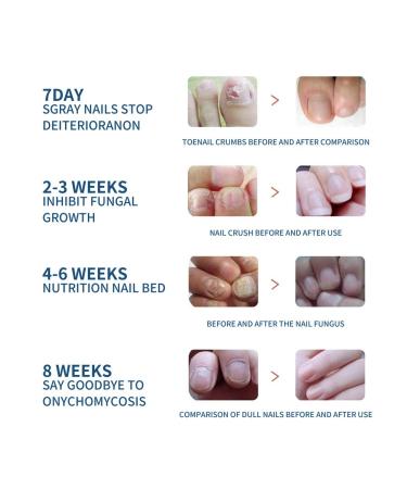 Eelhoe fungus of a gray nail thickening restoration manual ... - Buy Online on GoSupps.com