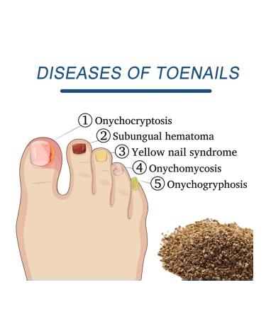 Eelhoe fungus of a gray nail thickening restoration manual ... - Buy Online on GoSupps.com