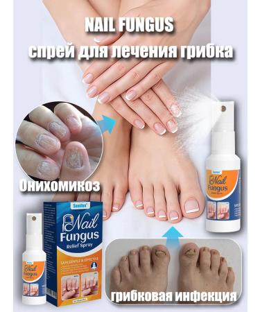 Nail Fungus spray from nail fungus on the legs of onychomycosis 30 ml