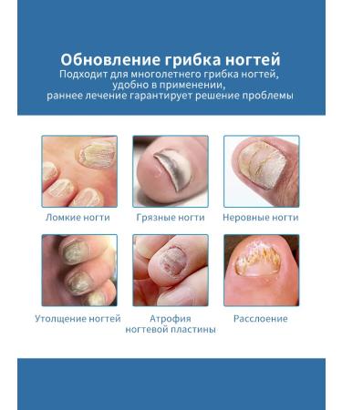 Nail Fungus spray from nail fungus on the legs of onychomycosis 30 ml - Buy Online on GoSupps.com