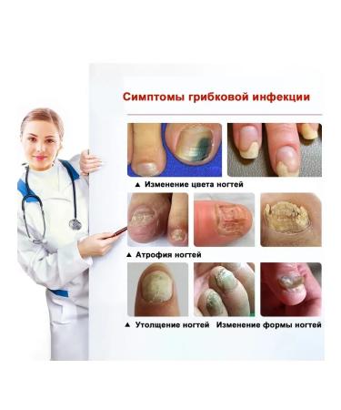 Nail Fungus spray from nail fungus on the legs of onychomycosis 30 ml - Buy Online on GoSupps.com