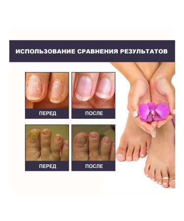 Serum to restore thickened nails with onykhomico ... - Buy Online on GoSupps.com