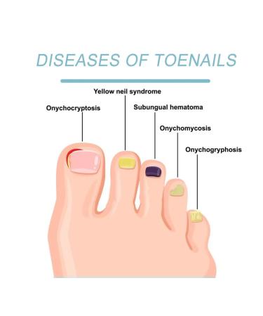 Device for thickened nails with onychomycosis - Buy Online on GoSupps.com