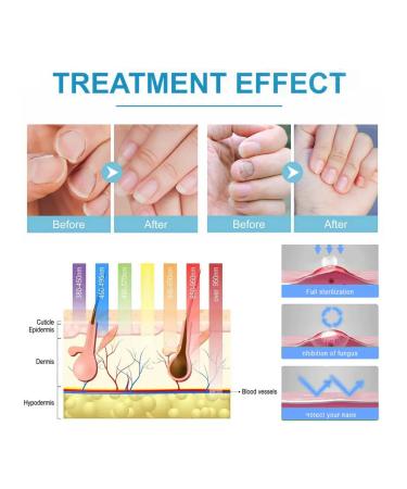 Device for thickened nails with onychomycosis - Buy Online on GoSupps.com