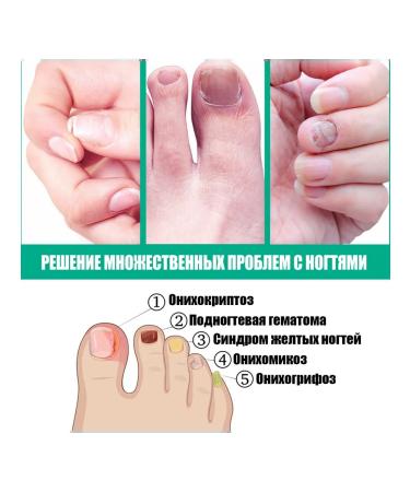 Kerassentials - Tratamiento nails from fungi - Buy Online on GoSupps.com