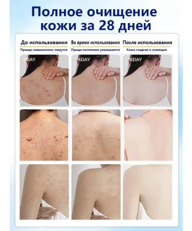 IUALLURE Shower gel against acne 300 ml - Buy Online on GoSupps.com