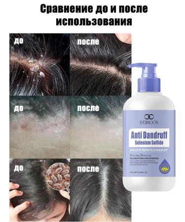 LYDIMOON Shampoo against dandruff with selenium disulfide 300 ml*5 - Buy Online on GoSupps.com