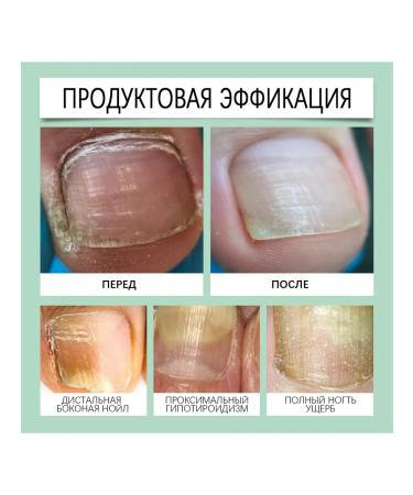 SOUTH MOON Nail fungus Care repair handle deep pure sterilization - Buy Online on GoSupps.com
