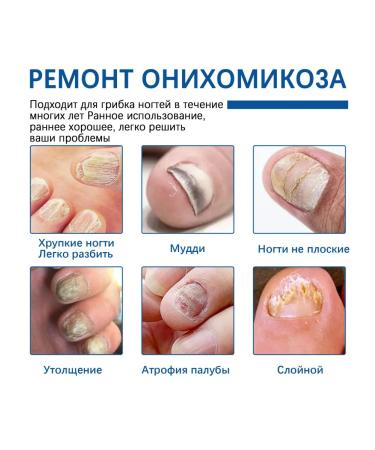 Nail fungus Treatment to moisturize fluid reduce itching pain pain - Buy Online on GoSupps.com