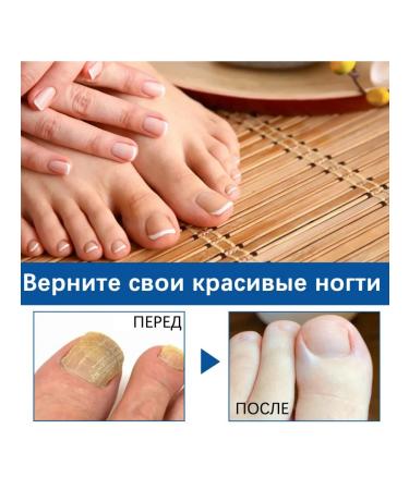 Nail fungus Treatment to moisturize fluid reduce itching pain pain - Buy Online on GoSupps.com