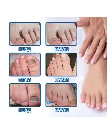 Nail fungus Treatment to moisturize fluid reduce itching pain pain - Buy Online on GoSupps.com