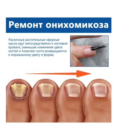 Nail fungus Treatment to moisturize fluid reduce itching pain pain - Buy Online on GoSupps.com