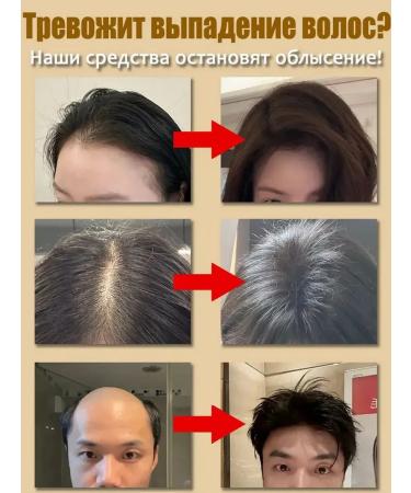 LYDIMOON Shampoo from hair loss for growth 300ml*5 - Buy Online on GoSupps.com